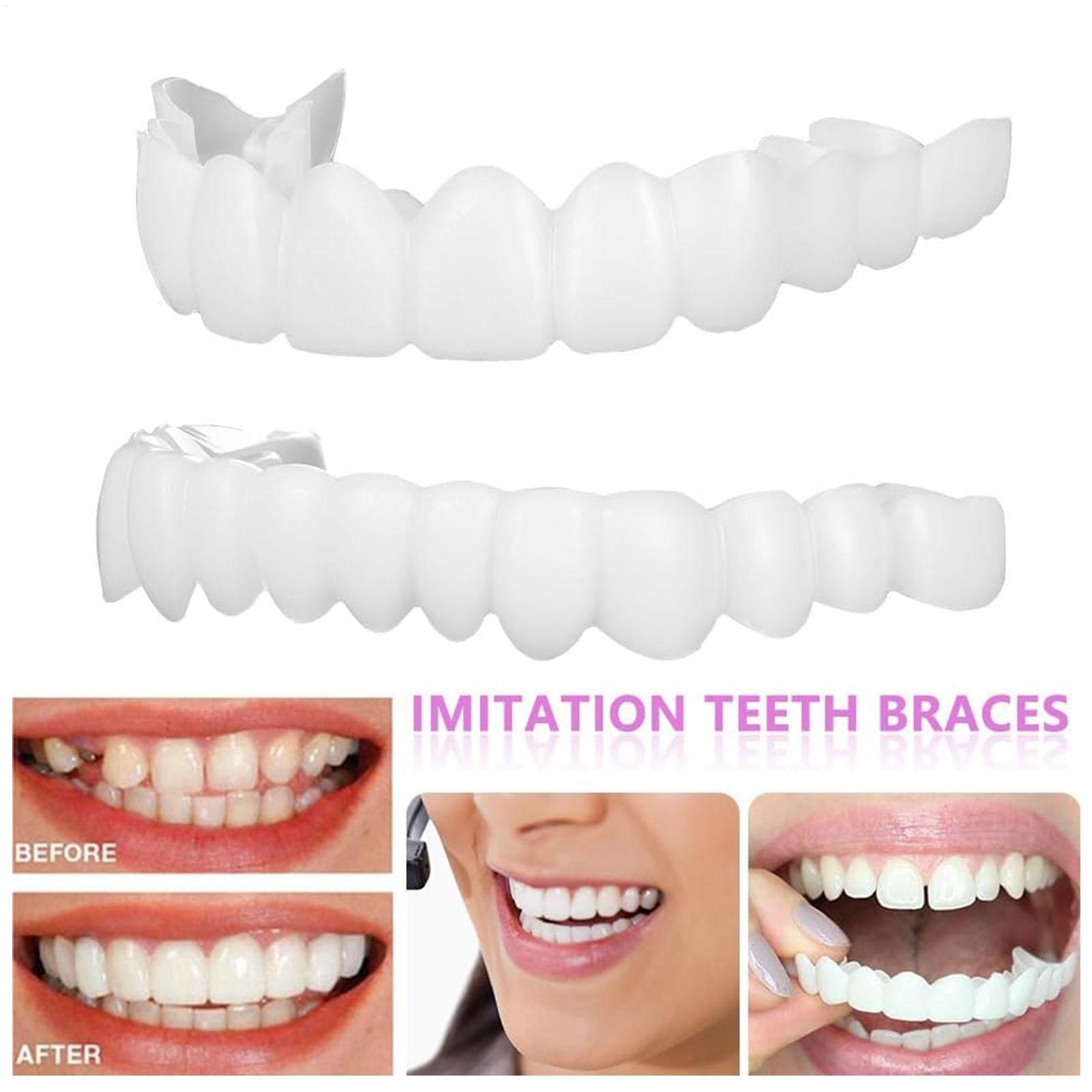 Teeth Whitening With Braces - Diş Üst Alt Takma Diş Kaplaması