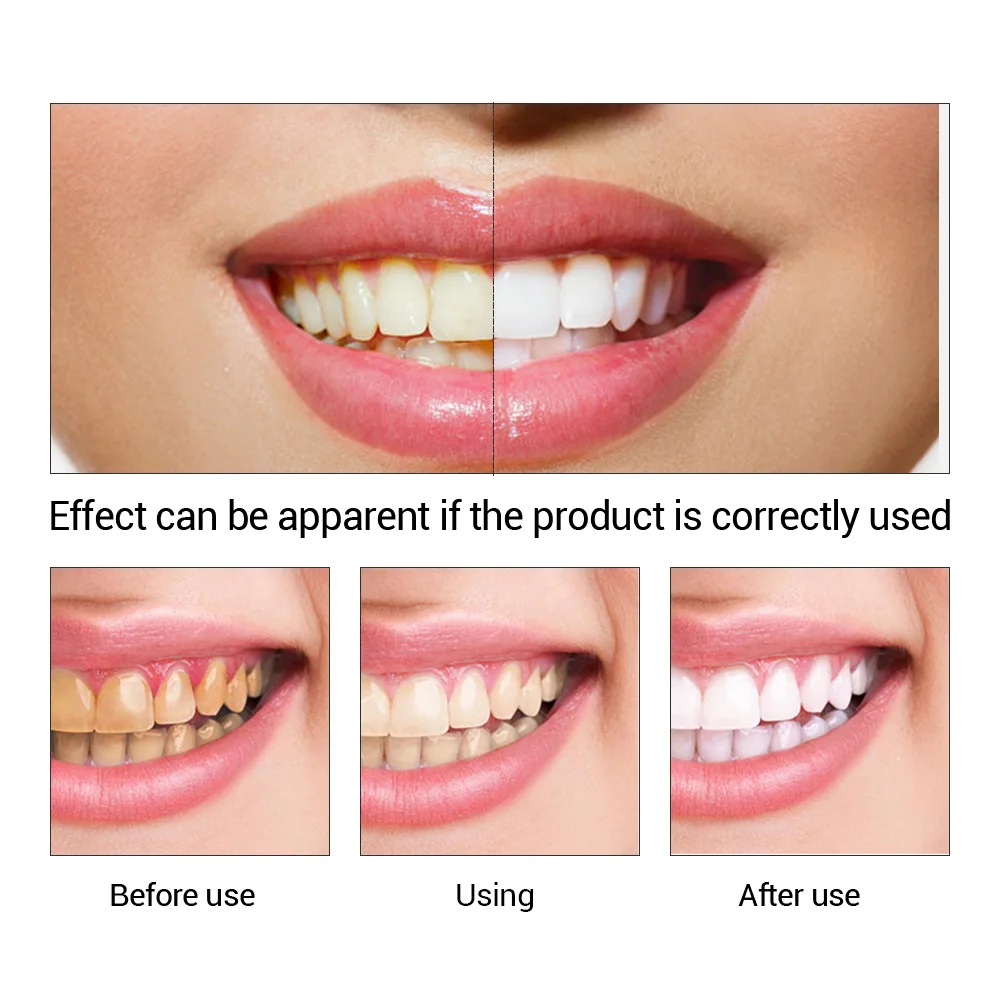 FTEENPLY diş beyazlatma özü to - Teeth Whitening Flash incelemesi ve fiyatı