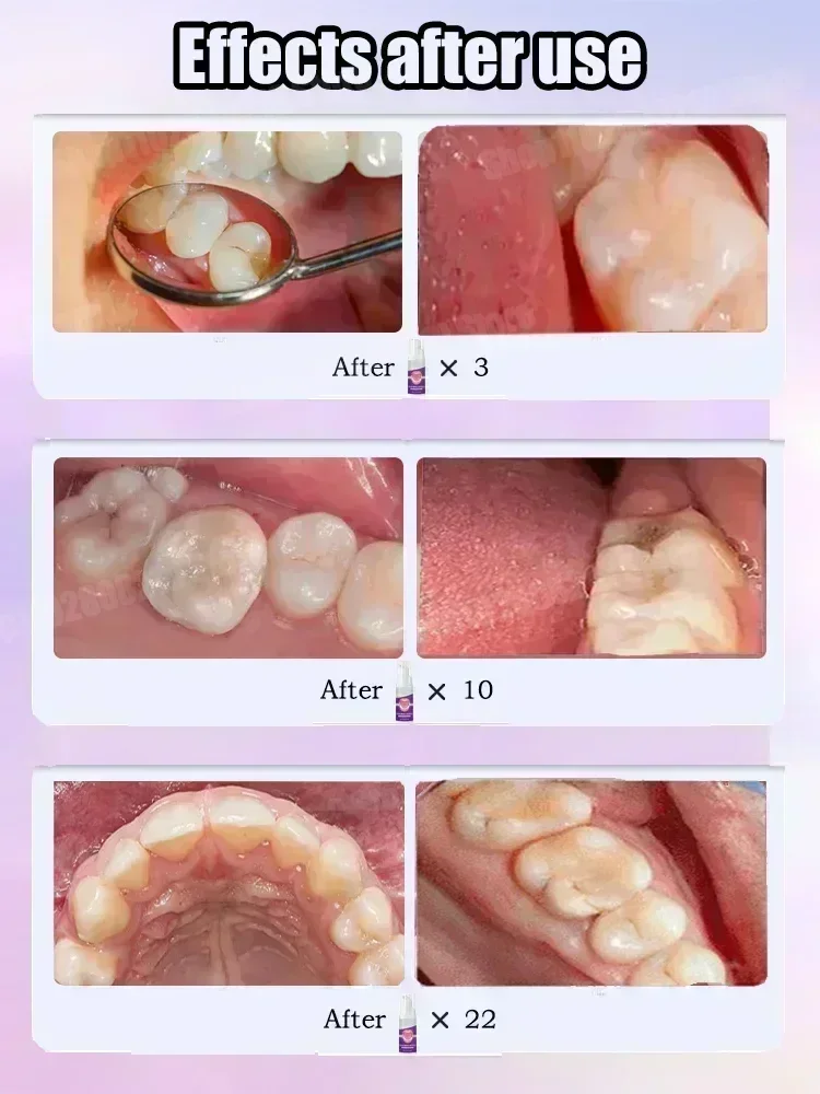 Diğer Diş Temizleme Ürünleri D - Teeth Whitening Treatment incelemesi ve fiyatı